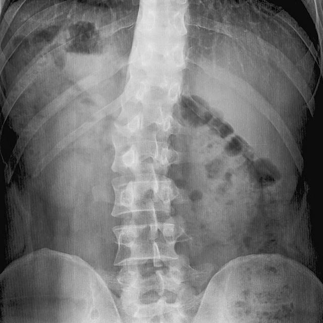 Two x-ray images show spine curvature indicating scoliosis
