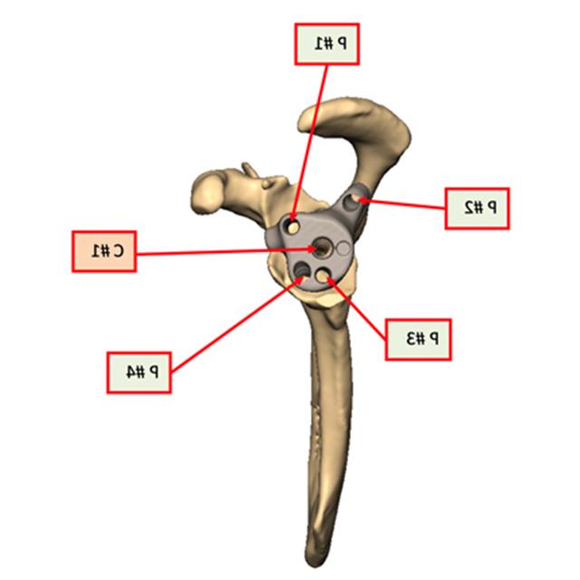 A diagram shows the locations and different screw lengths and types used in a reverse total shoulder arthroplasty.