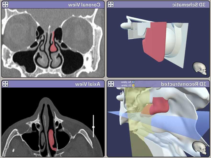 Screenshot from The Johns Hopkins Virtual Sinus Simulator.