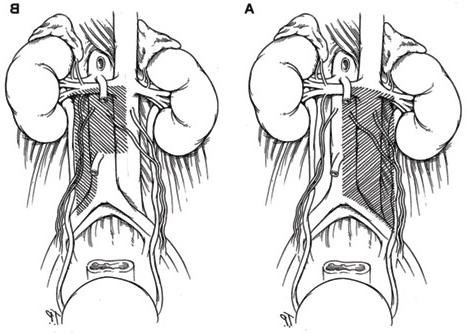 Illustration of two different dissection methods
